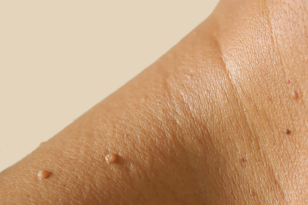 A closeup of a person with skin tags going for Skin Tag treatment at Assure Aesthetics clinic in St Albans